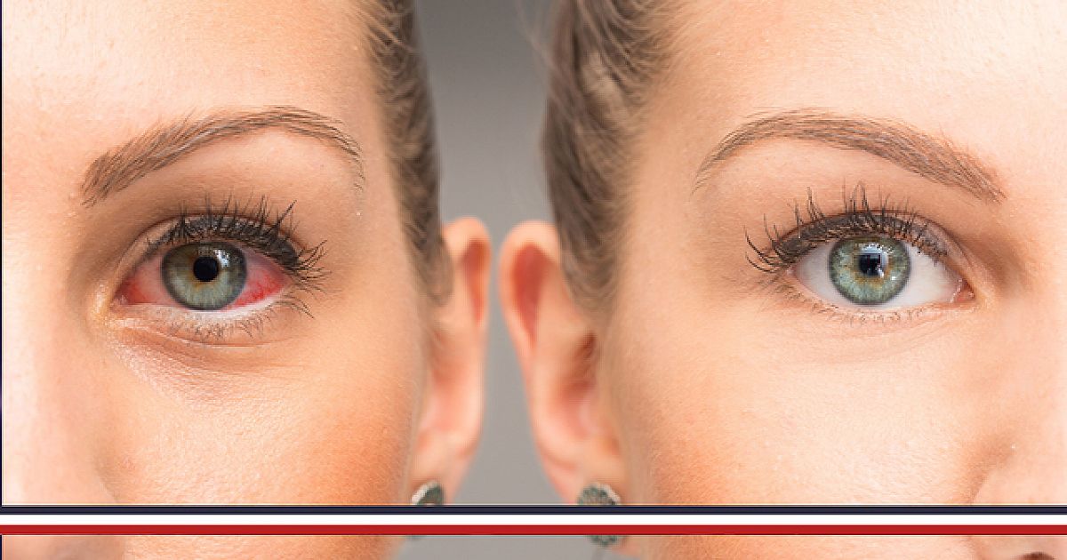 Que faire en cas de projection de e-liquide dans les yeux ? Que faire en cas de projection de e-liquide dans les yeux ?